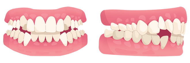 Crowding teeth illustration