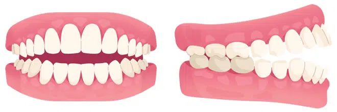 Open bite illustration, showing teeth before orthodontic treatment