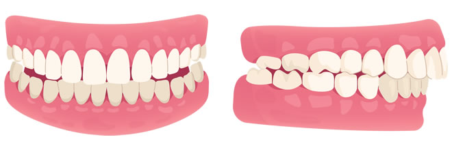 Specialist Orthodontic care treating overbites