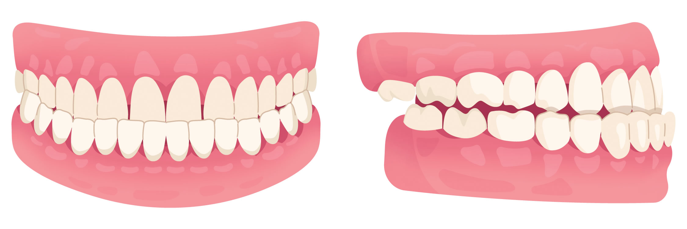 Under bite illustration showing teeth before orthodontic treatment