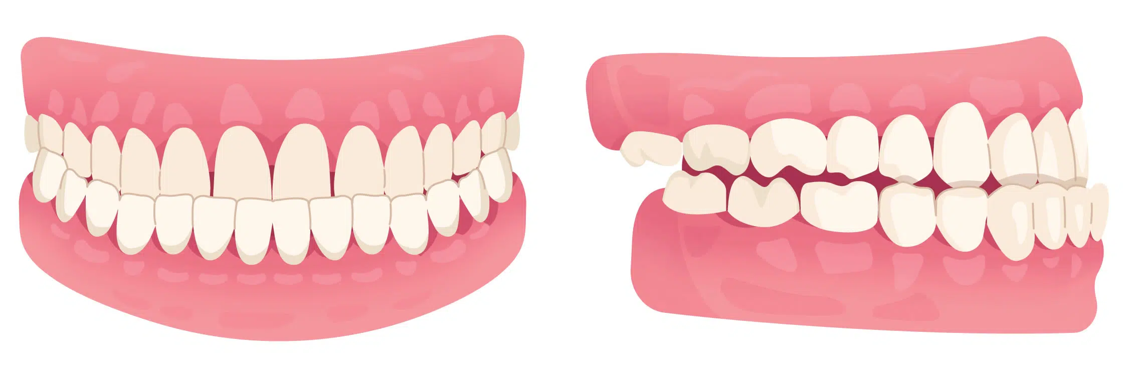 Under bite illustration showing teeth before orthodontic treatment